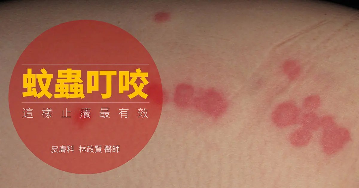 「被蚊子叮的好癢!」的英語該怎麼說?毛毛蟲、水母蜇人的表達方式也一併介紹