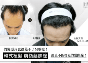 「假髮」的英文怎麼說？一起介紹「禿頭」的英文表達！