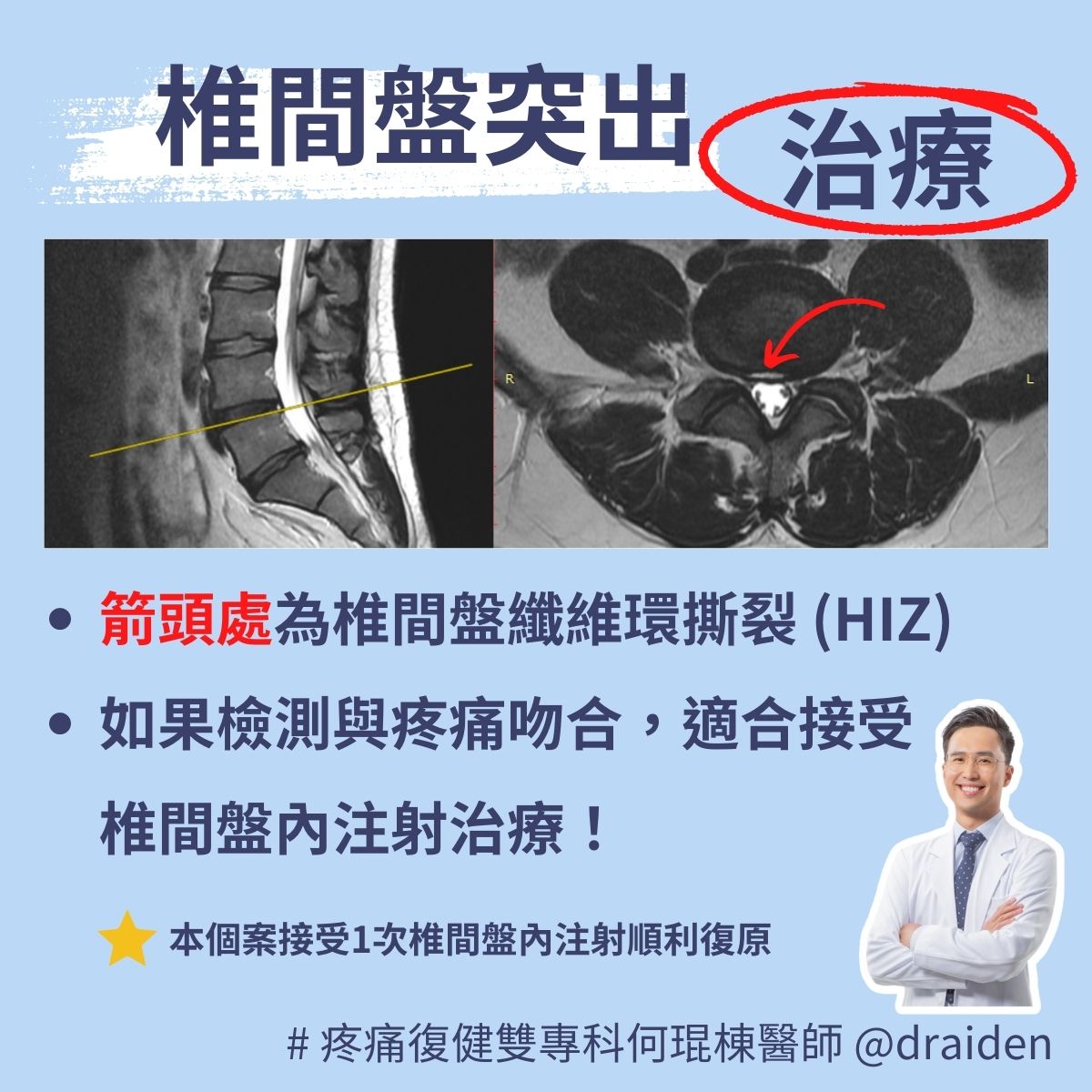 突然「閃到腰」用英文怎麼說?一併介紹其他與腰相關的英文!