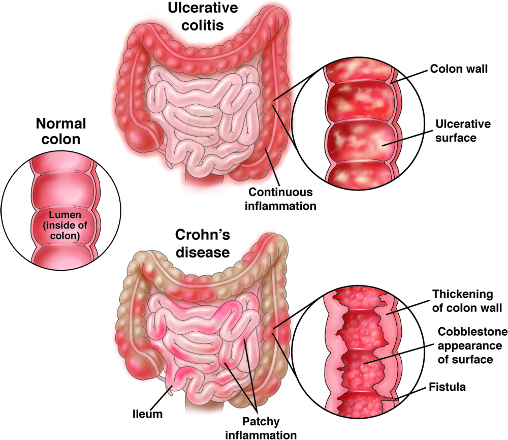 Major cause of inflammatory bowel disease found 英國科學傢找到炎癥性腸病的主要病因