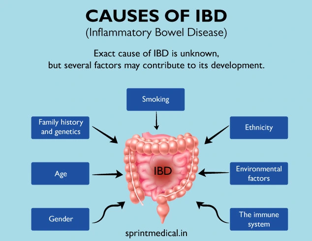 Major cause of inflammatory bowel disease found 英國科學傢找到炎癥性腸病的主要病因